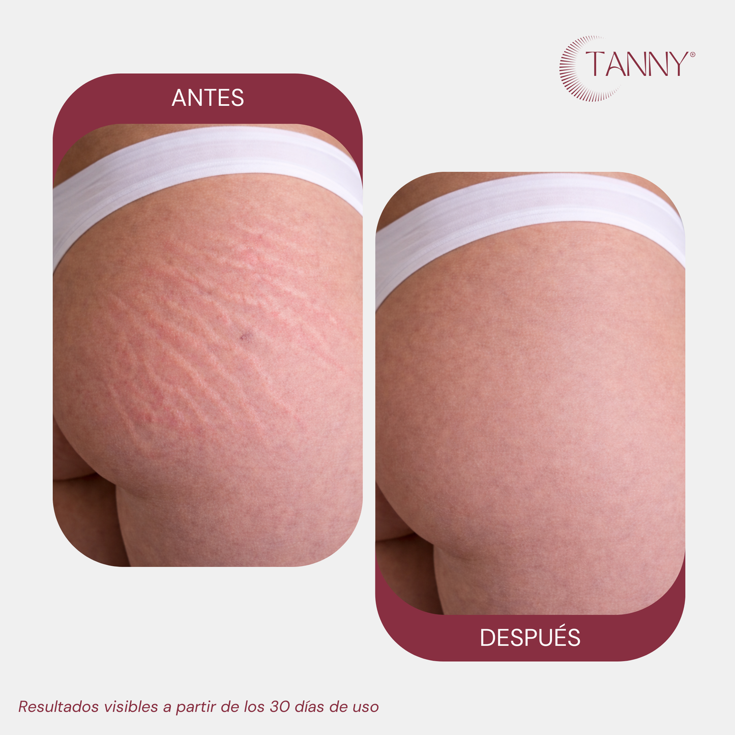 Tratamiento Intensivo Para Estrías Corporal