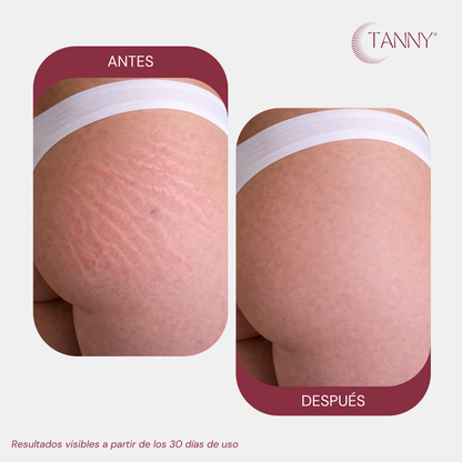 Tratamiento Intensivo Para Estrías Corporal