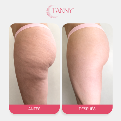 Tratamiento Para Celulitis Reafirmante Corporal