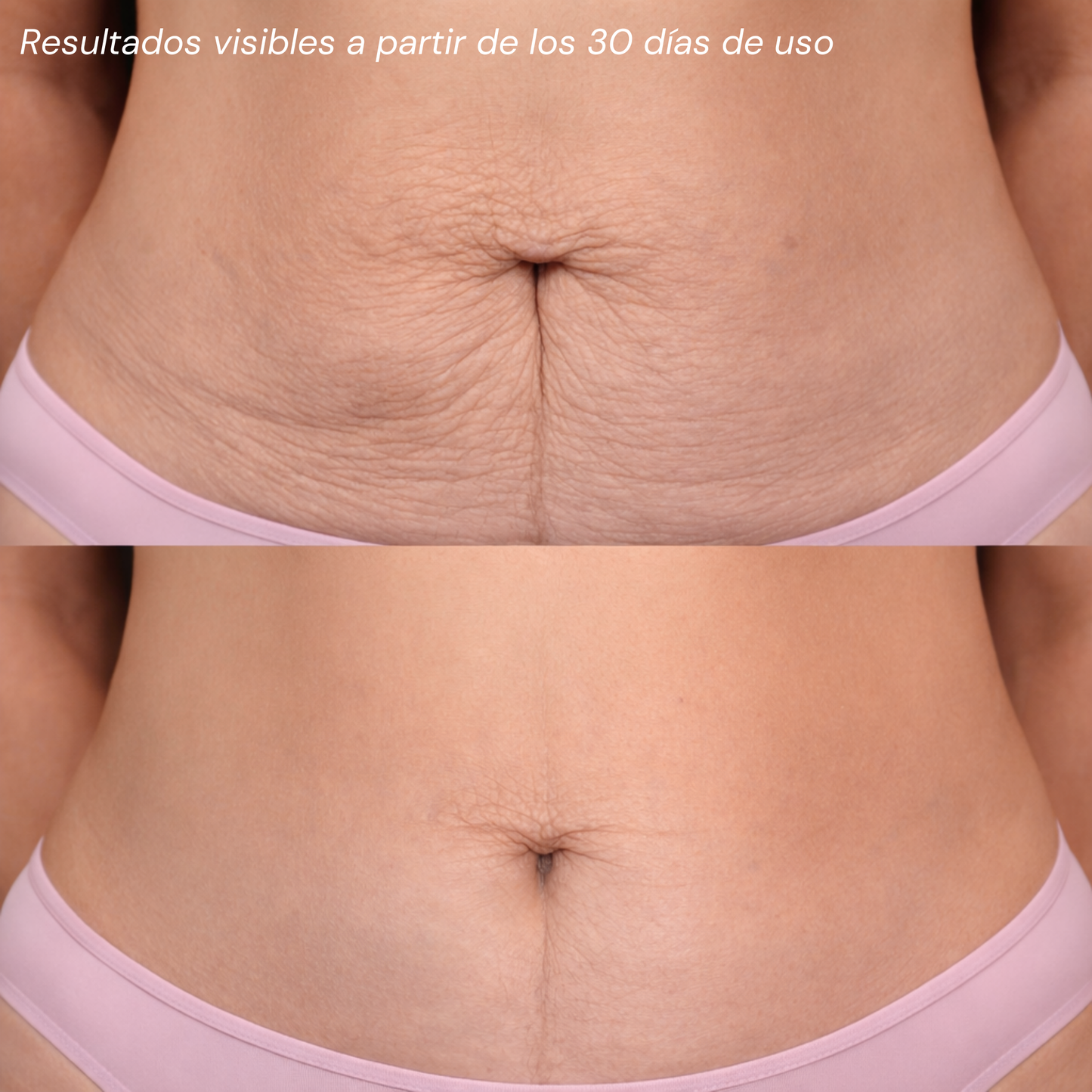 Tratamiento Para Celulitis Reafirmante Corporal