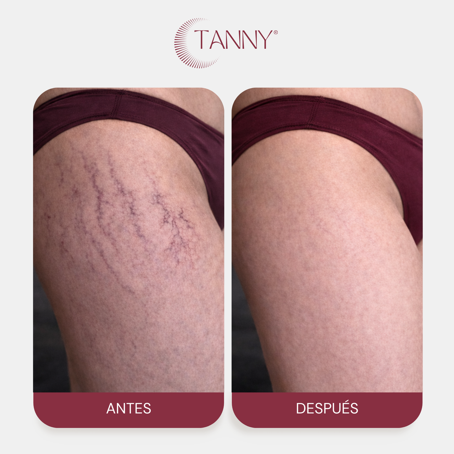 Tratamiento Intensivo Para Estrías Corporal